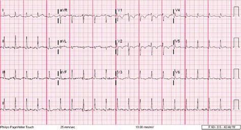 borderline ecg meaning